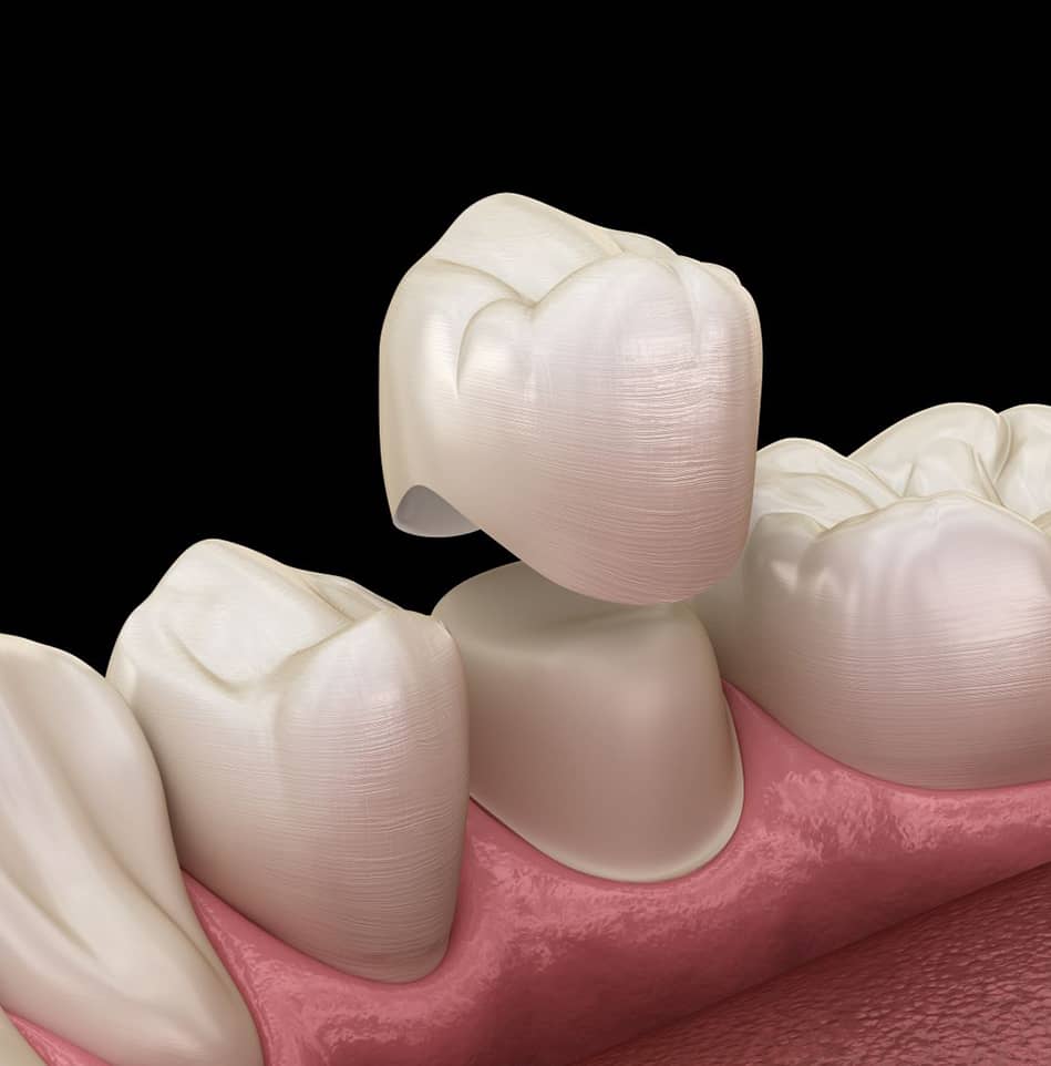 dental crowns in jupiter