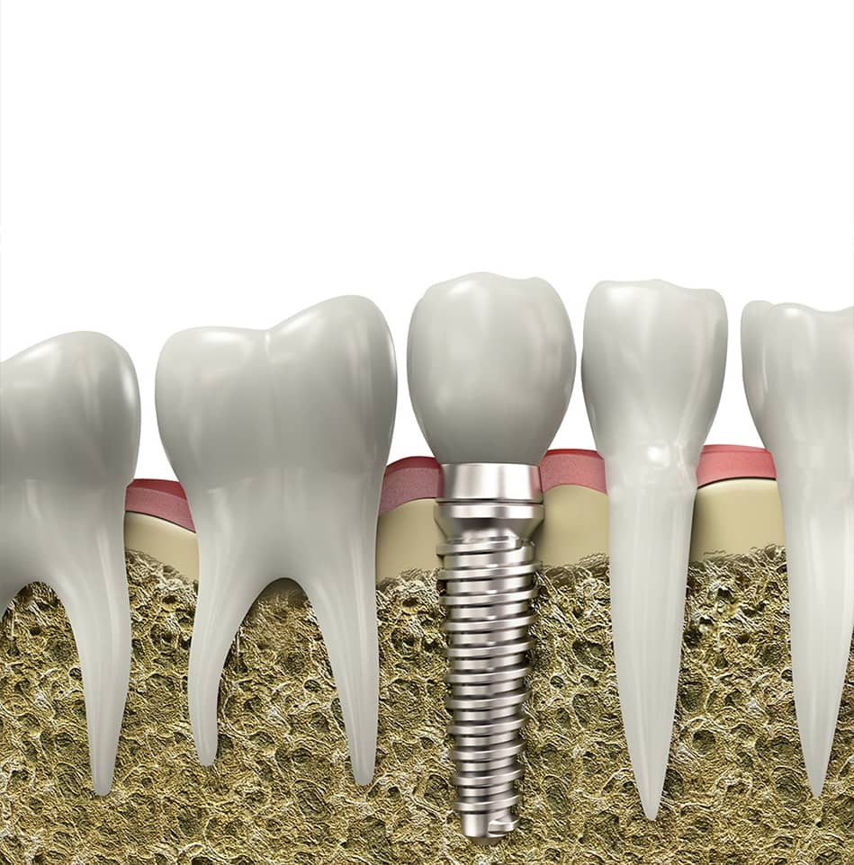 dental implants in jupiter