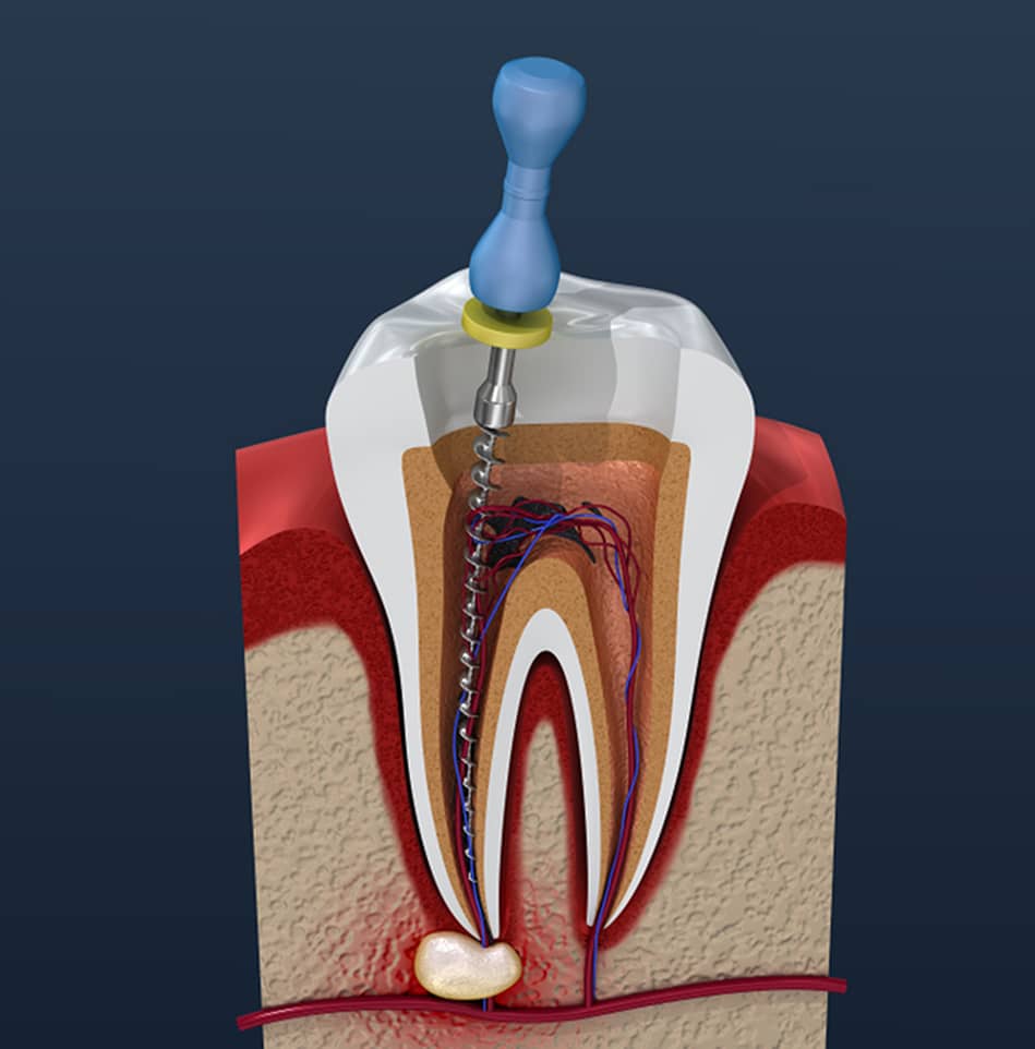 root canal therapy in jupiter