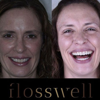 teeth cleaning with flosswell dental