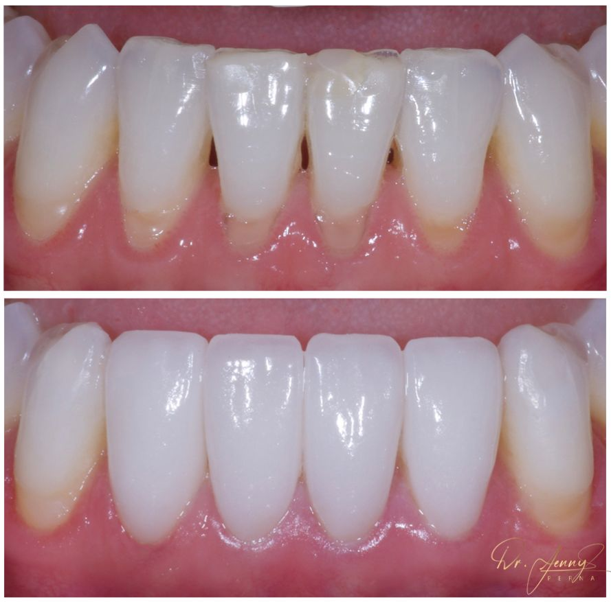 4 Lower Veneers