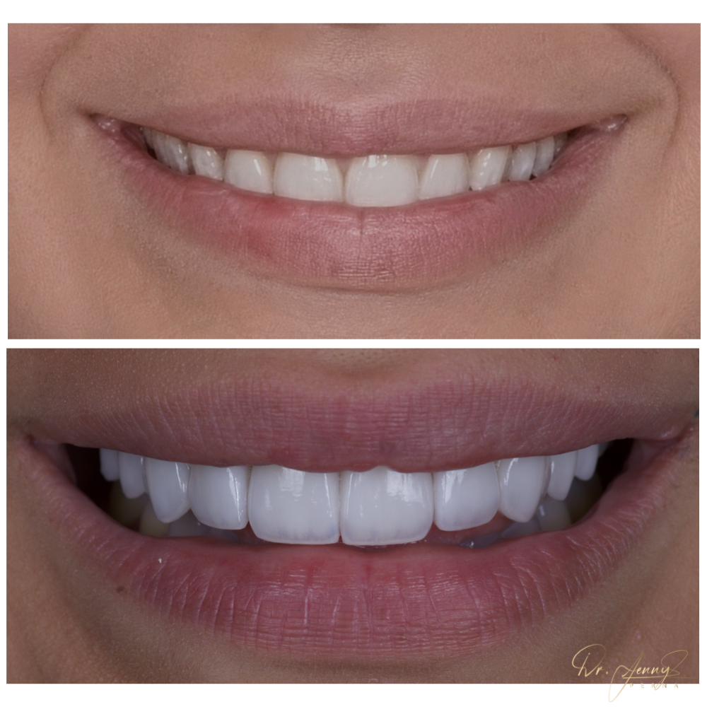 Before&After
