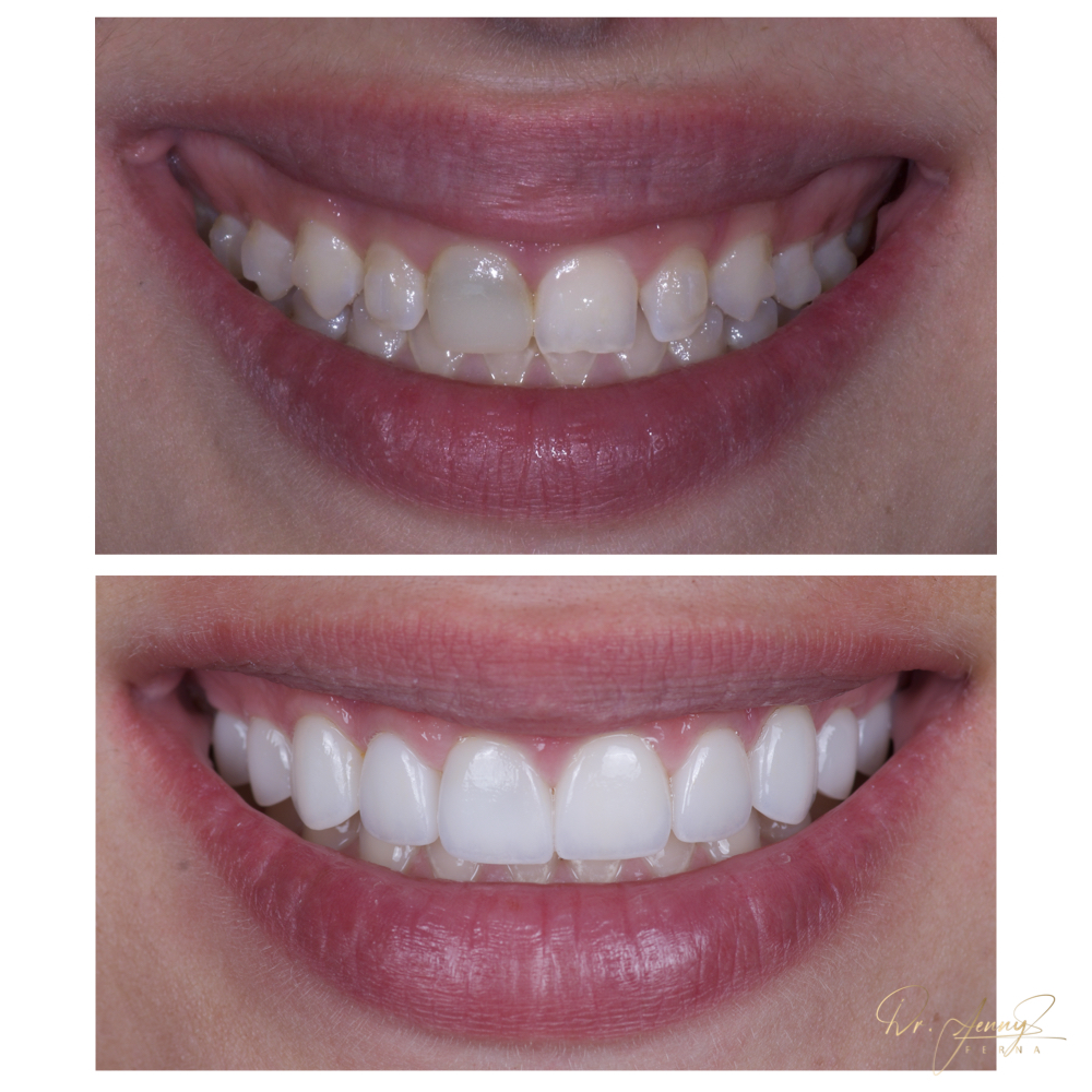 Invisalign and Veneers