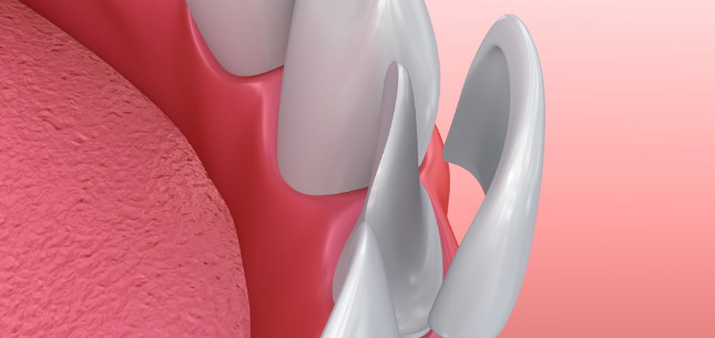 dental veneers 1