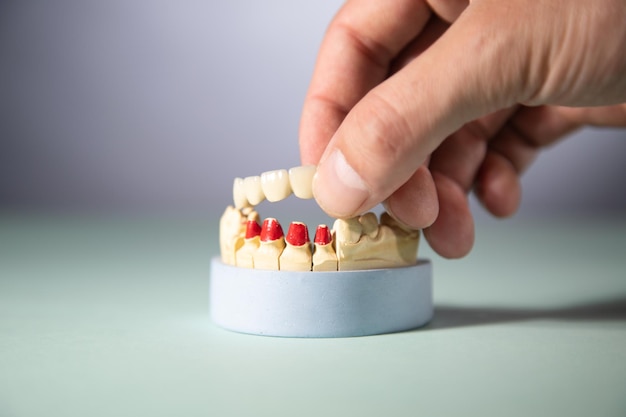 how dental bridges restore confidence