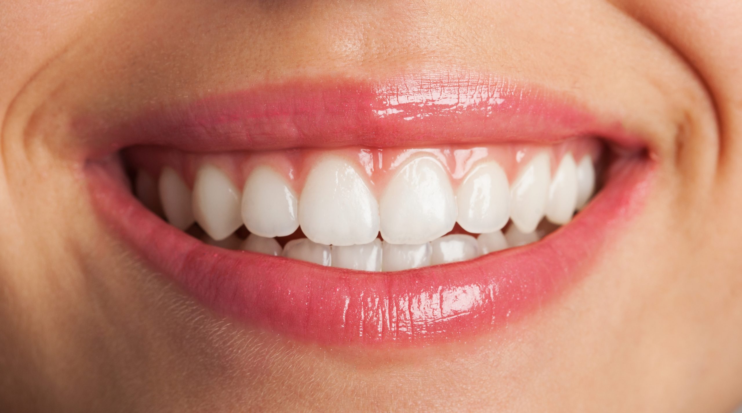 Teeth Whitening vs Store-Bought Kits